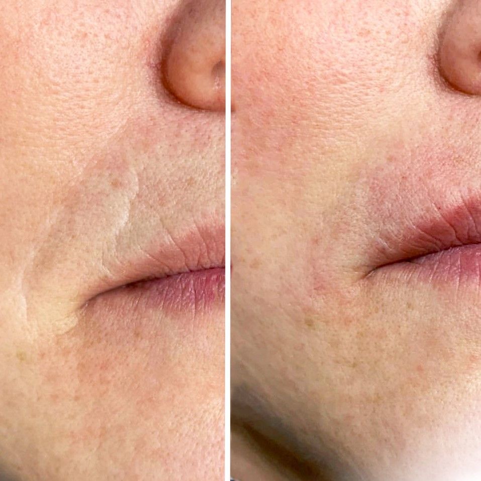 HIALUROPEN , HACIDO HIALURONICO ,ENTRECEJO Y NASOGENIANO,MALLORCA ESTETICA MOURE (5)