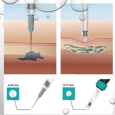 HIALUROPEN TECNICA Y APARATOLOGIA MALLORCA CENTROS MOURE (4)