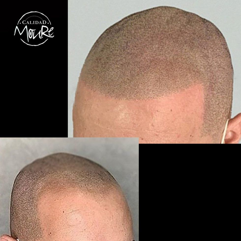 Micropigmentación Mallorca. Centros Moure. OFERTA DE MICROPIGMENTACIÓN CAPILAR 290€. 1 sesión de 2 horas. Técnica pelo a pelo o punteado.