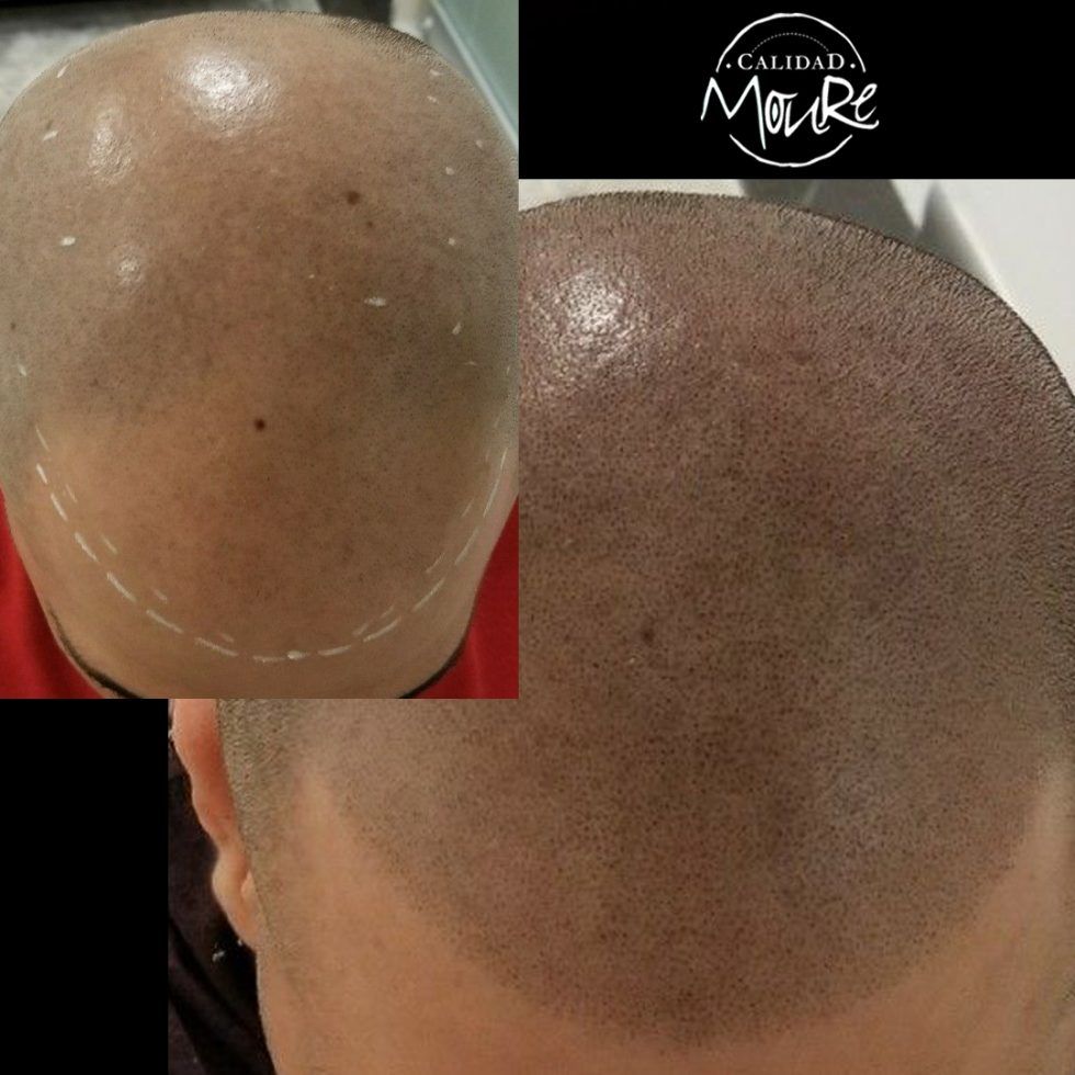 Micropigmentación Mallorca. Centros Moure. OFERTA DE MICROPIGMENTACIÓN CAPILAR 290€ 1 sesión de 2 horas Técnica pelo a pelo o punteado