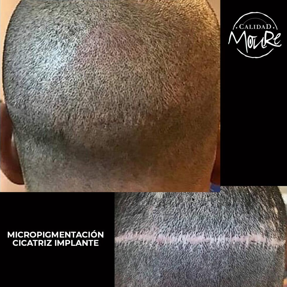 Micropigmentación Capilar Mallorca. Cicatrices. OFERTA DE MICROPIGMENTACIÓN CAPILAR POR SOLO 290€ Una sesión de dos horas de Micropigmentación Capilar. Técnica pelo a pelo o punteado.