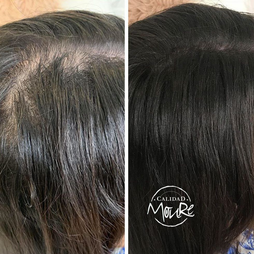 Micropigmentación Mallorca. Centros Moure. OFERTA DE MICROPIGMENTACIÓN CAPILAR 290€. 1 sesión de 2 horas. Técnica pelo a pelo o punteado.