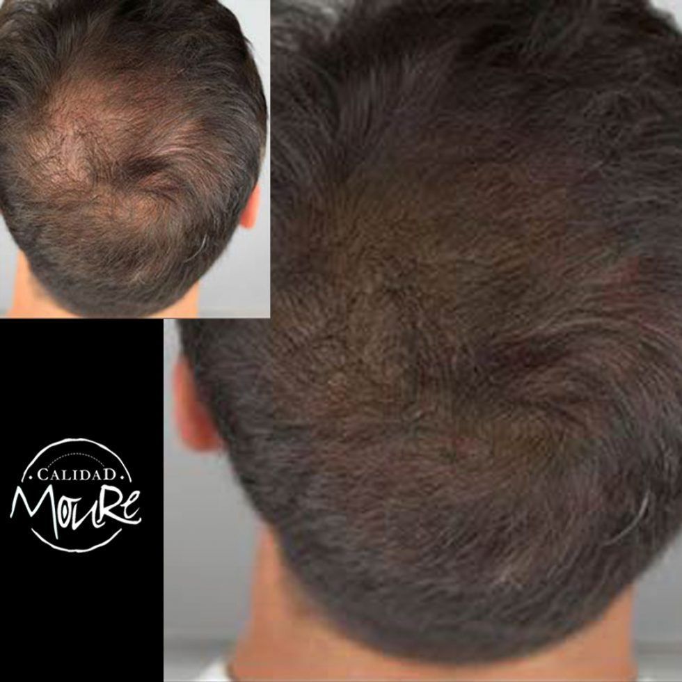 Micropigmentación Capilar Mallorca. Relleno Pelo Largo. OFERTA DE MICROPIGMENTACIÓN CAPILAR POR SOLO 290€ Una sesión de dos horas de Micropigmentación Capilar. Técnica pelo a pelo o punteado.