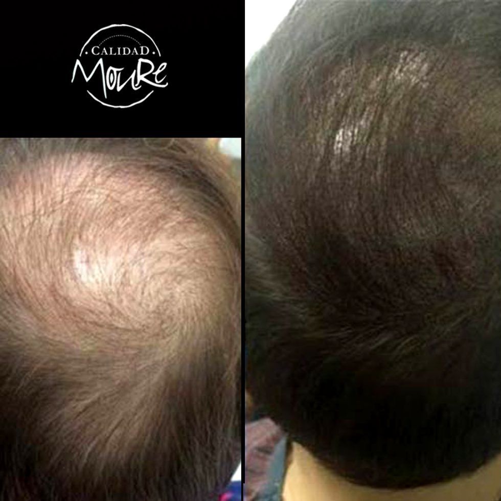 Micropigmentación Capilar Mallorca. Relleno Pelo Largo. OFERTA DE MICROPIGMENTACIÓN CAPILAR POR SOLO 290€ Una sesión de dos horas de Micropigmentación Capilar. Técnica pelo a pelo o punteado.