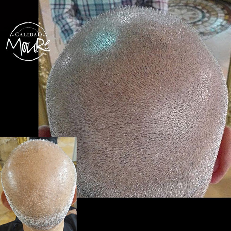 Micropigmentación Capilar Mallorca. Relleno Pelo Largo. OFERTA DE MICROPIGMENTACIÓN CAPILAR POR SOLO 290€ Una sesión de dos horas de Micropigmentación Capilar. Técnica pelo a pelo o punteado.