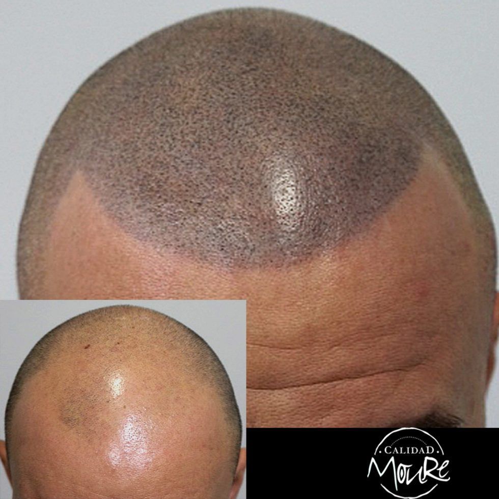 Micropigmentación Capilar Mallorca. Técnica Detalle Rasurado. OFERTA DE MICROPIGMENTACIÓN CAPILAR POR SOLO 290€ Una sesión de dos horas de Micropigmentación Capilar. Técnica pelo a pelo o punteado.