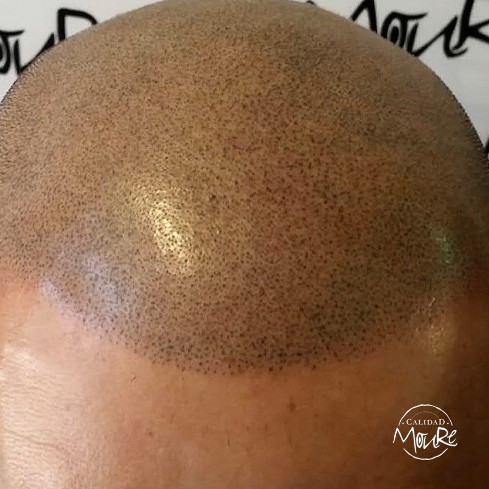 Micropigmentación Capilar Mallorca. Técnica Detalle Rasurado. OFERTA DE MICROPIGMENTACIÓN CAPILAR POR SOLO 290€ Una sesión de dos horas de Micropigmentación Capilar. Técnica pelo a pelo o punteado.