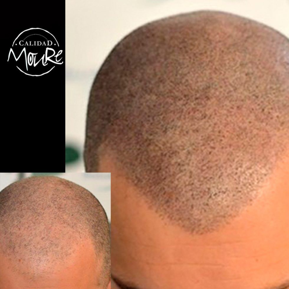 Pasos de la Micropigmentación Capilar Mallorca. OFERTA DE MICROPIGMENTACIÓN CAPILAR POR SOLO 290€ Una sesión de dos horas de Micropigmentación Capilar. Técnica pelo a pelo o punteado.