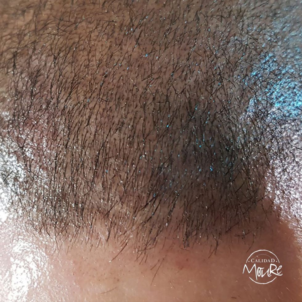 Micropigmentación Capilar Mallorca. Calvicie relleno pelo largo. OFERTA DE MICROPIGMENTACIÓN CAPILAR POR SOLO 290€ Una sesión de dos horas de Micropigmentación Capilar. Técnica pelo a pelo o punteado.