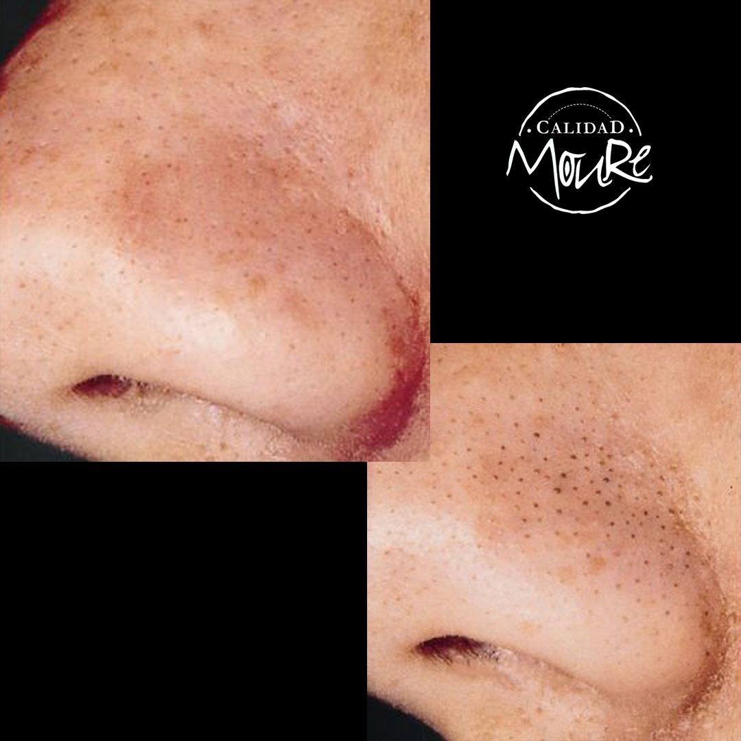 ANTES Y DESPUES DE LIMPIEZA POR ULTRASONIDOS PUNTOS NEGROS E IMPUREZAS (2)