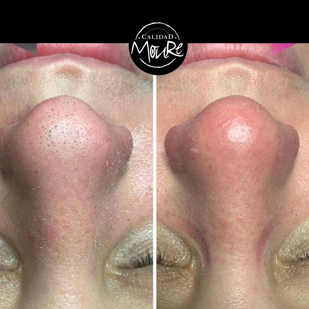 ANTES Y DESPUES DE LIMPIEZA POR ULTRASONIDOS PUNTOS NEGROS E IMPUREZAS (4)