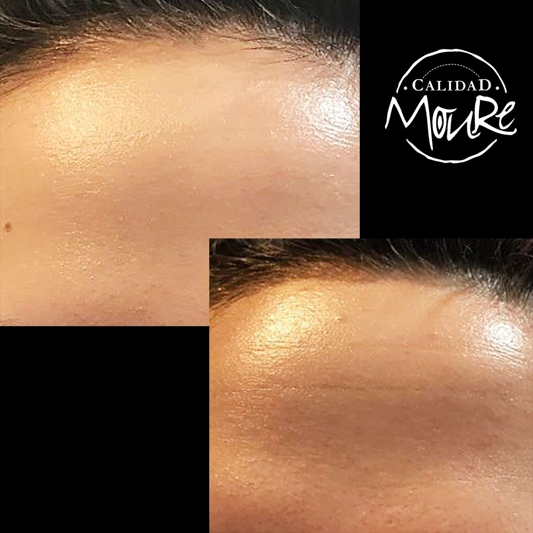 ANTES Y DESPUES DE LIMPIEZA POR ULTRASONIDOS PUNTOS NEGROS E IMPUREZAS (7)