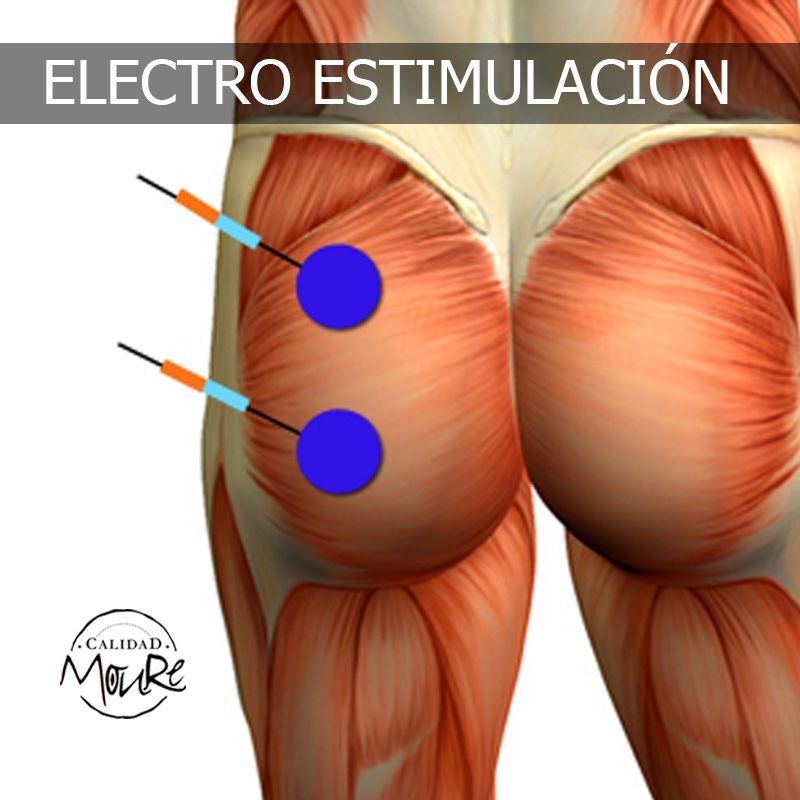 ELECTROESTIMULACIÓN TRATAMIENTO GLUTEOS
