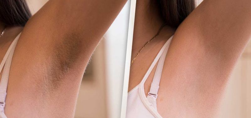 FOTODEPILACION LASER MOURE MUJER IPL LIGHT (7)