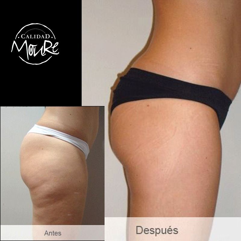 FOTOS DE ANTES Y DESPUES DE TRATAMIENTO DE REAFIRMACION DE GLUTEOS (1)