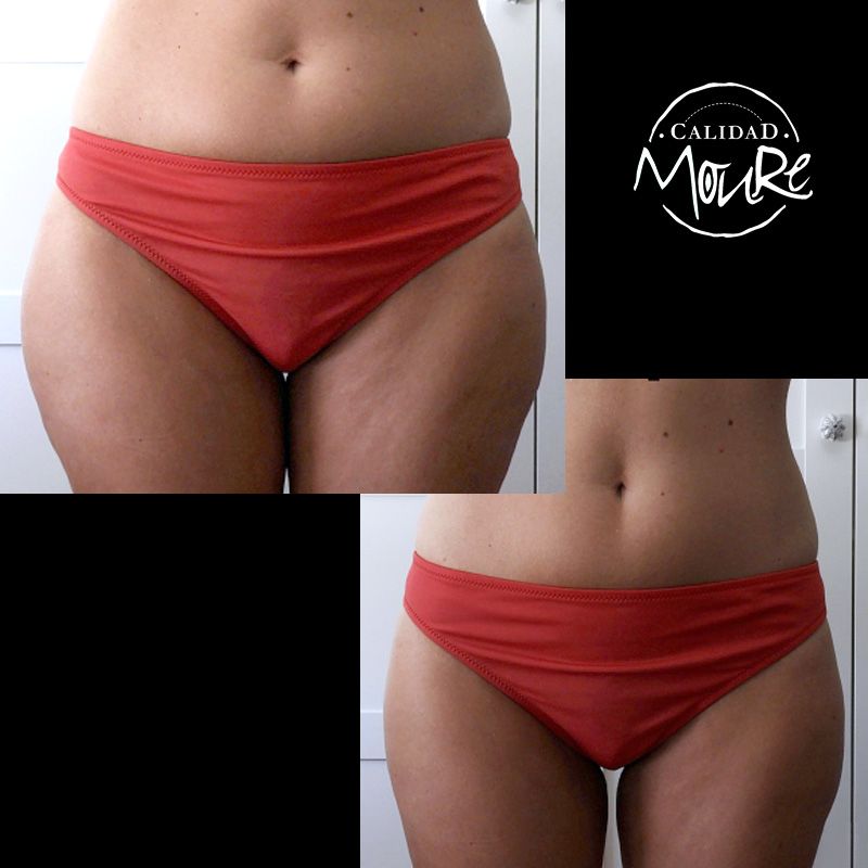 FOTOS DE RESULTADOS ANTES Y DESPUES DE TRATAMIENTO REDUCTOR CORPORAL MOURE MALLORCA (4)