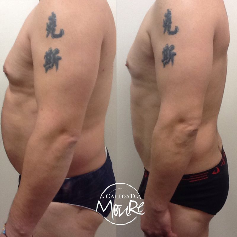 FOTOS DE RESULTADOS ANTES Y DESPUES DE TRATAMIENTO REDUCTOR CORPORAL MOURE MALLORCA (6)