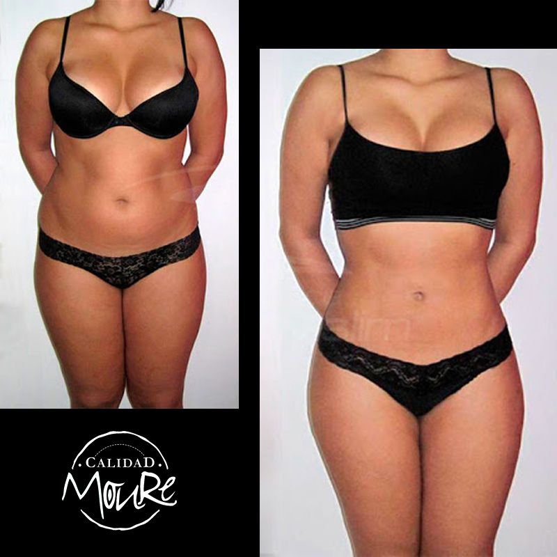 FOTOS DE RESULTADOS ANTES Y DESPUES DE TRATAMIENTO REDUCTOR CORPORAL MOURE MALLORCA (7)