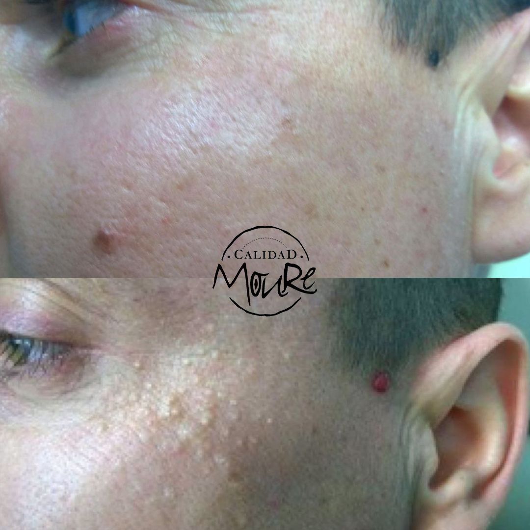 LIMPIEZA DE CUTIS ELIMINACION DE MILIUNS (1)