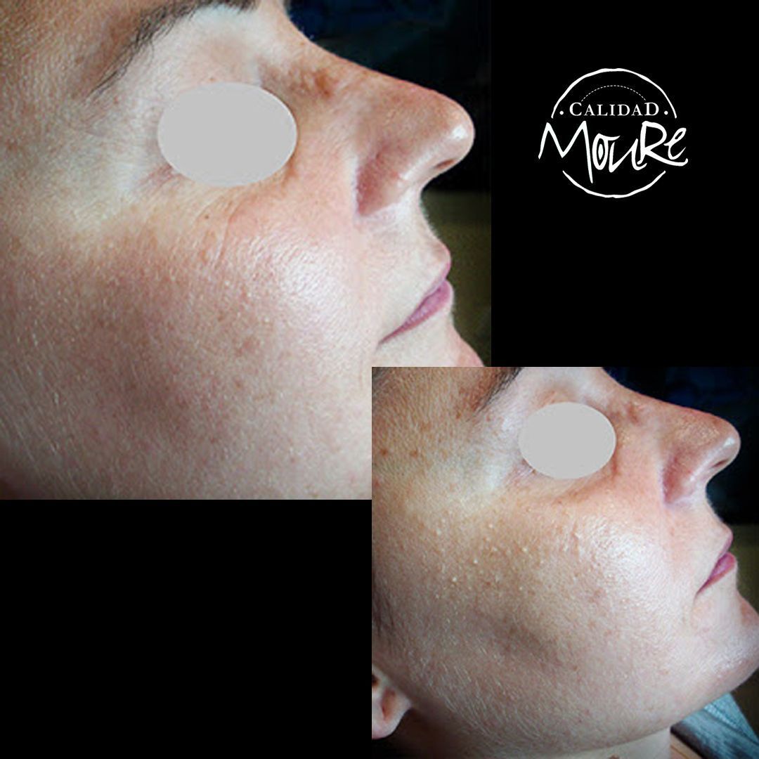 LIMPIEZA DE CUTIS ELIMINACION DE MILIUNS (2)
