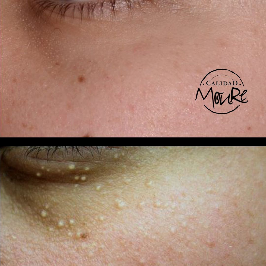 LIMPIEZA DE CUTIS ELIMINACION DE MILIUNS (3)
