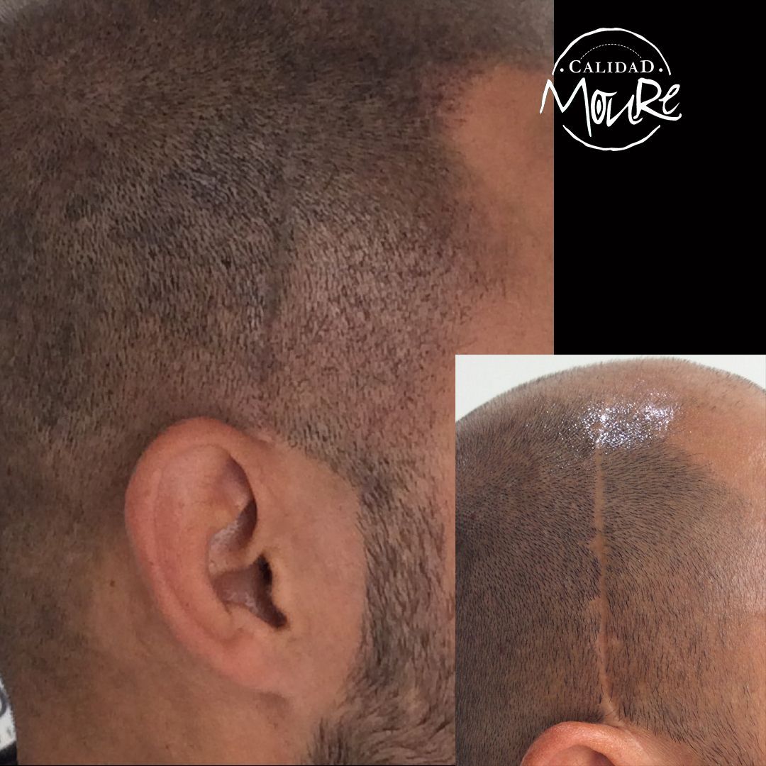 MICROPIGMENTACION CAPILAR CICATRICES MOURE (5)