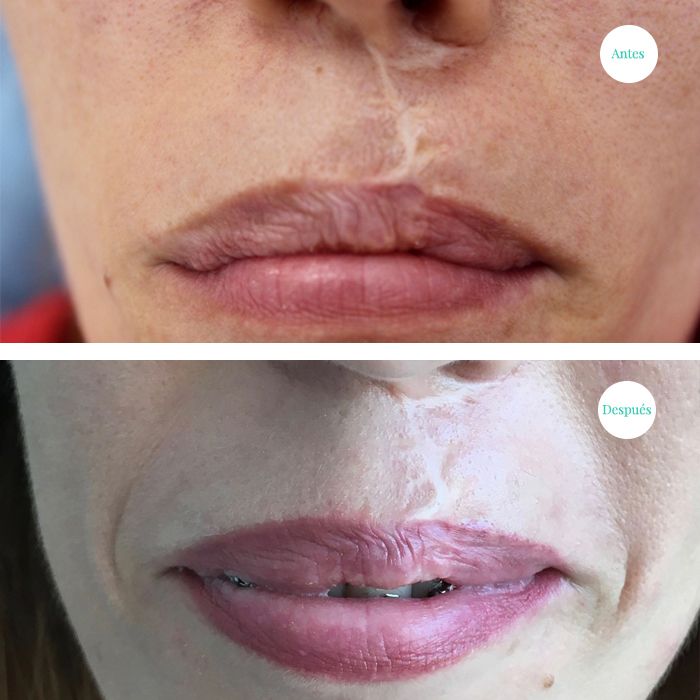 MICROPIGMENTACION CORRECCION DE LABIO CON CICATRIZ