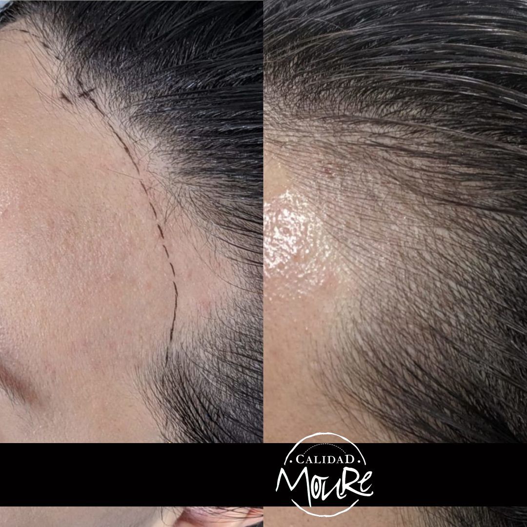 MICROPIGMENTACION MUJER MOURE MAS DENSIDAD PELO LARGO (12)