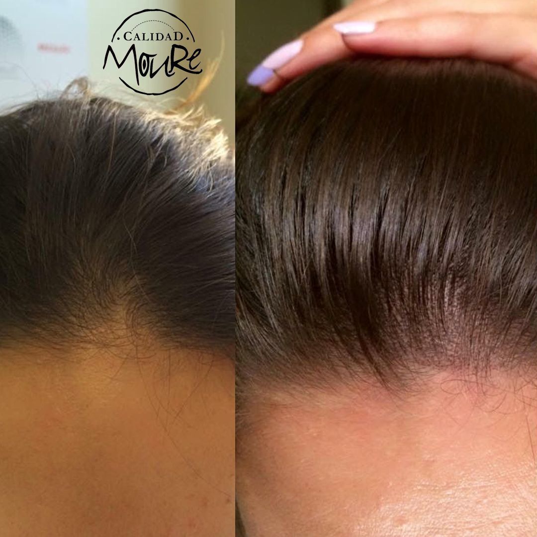 MICROPIGMENTACION MUJER MOURE MAS DENSIDAD PELO LARGO (13)