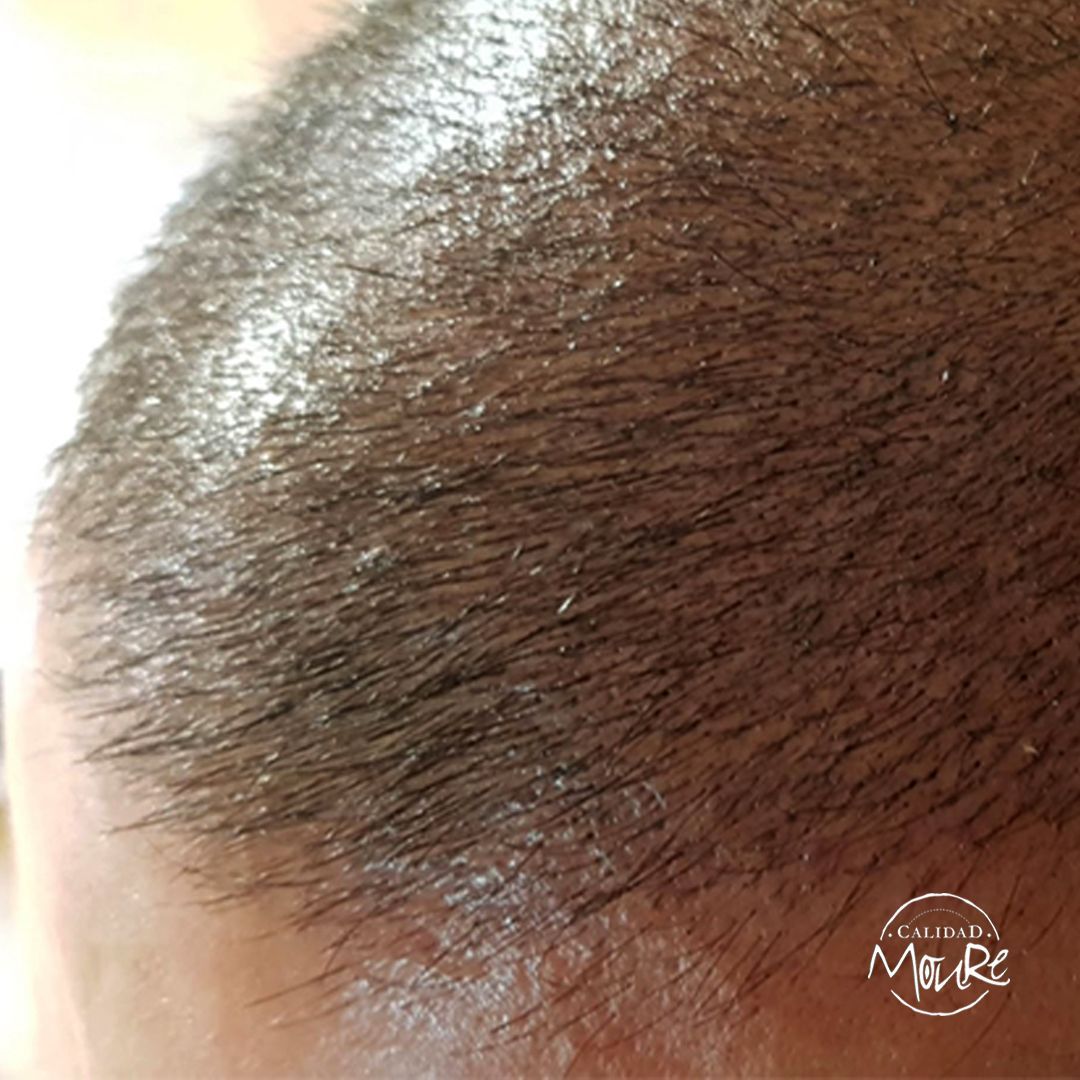 MICROPIGMENTACION RASURADO MOURE MALLORCA (12)