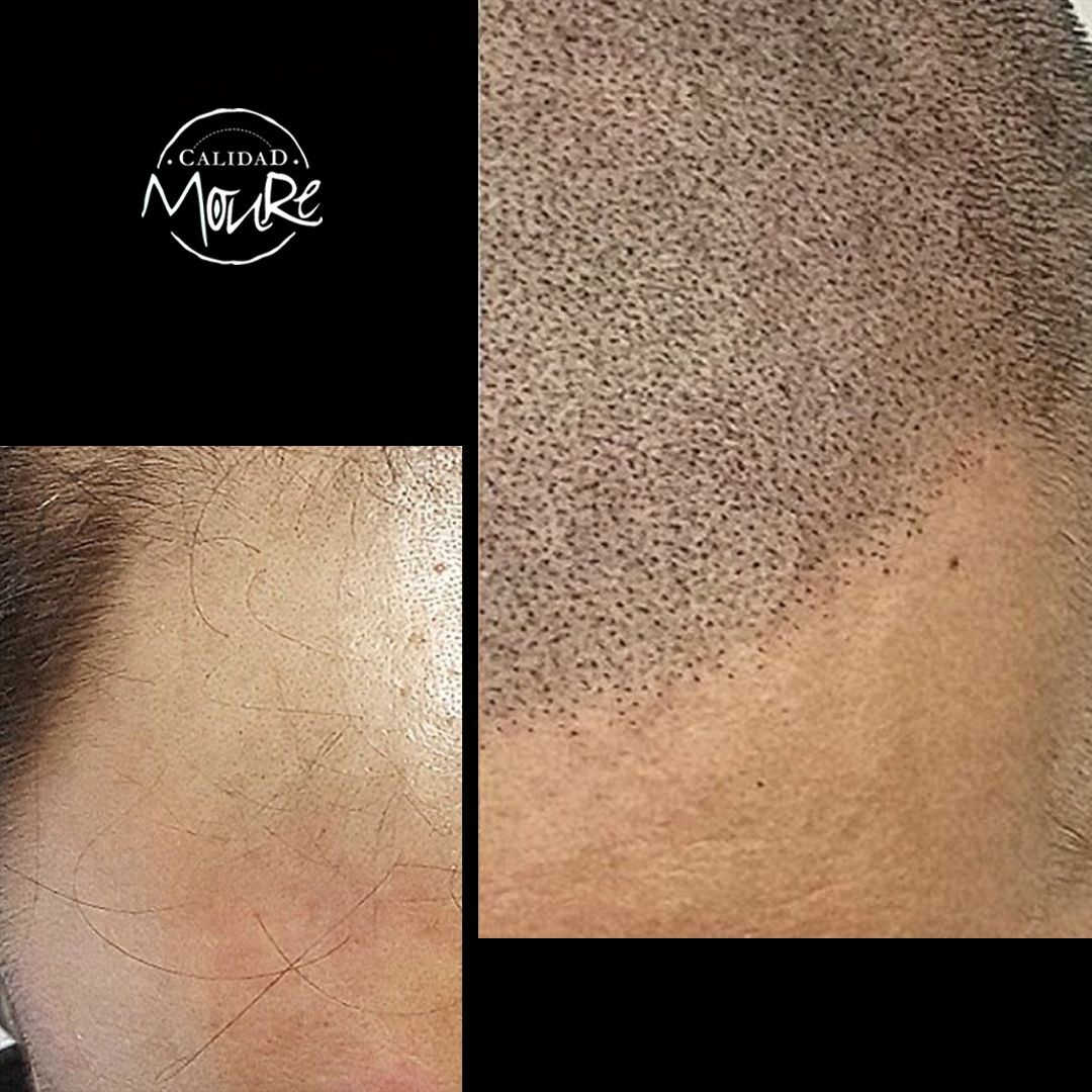 MICROPIGMENTACION RASURADO MOURE MALLORCA (2)