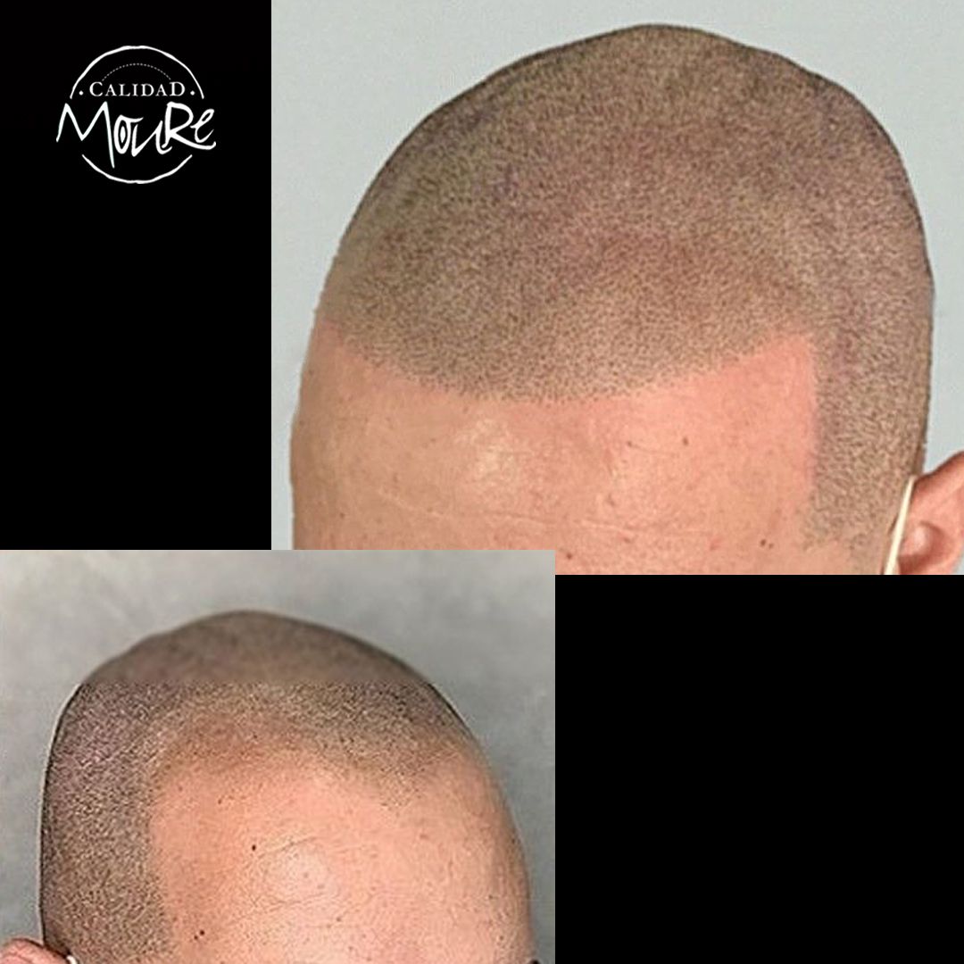 MICROPIGMENTACION RASURADO MOURE MALLORCA (3)