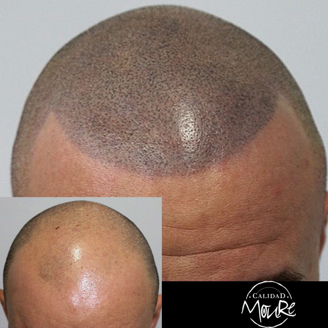 MICROPIGMENTACION RASURADO MOURE MALLORCA (7)