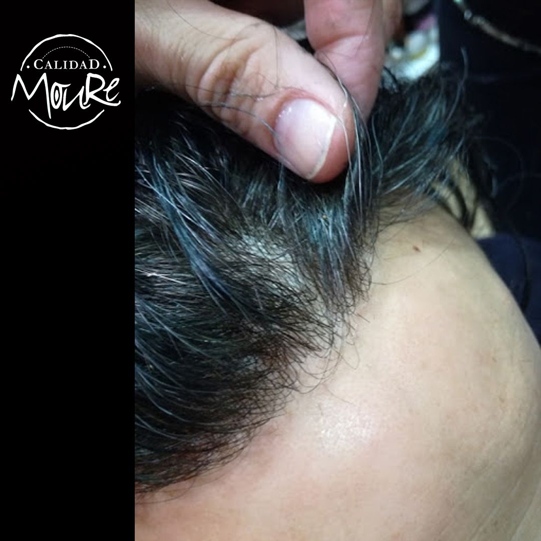 PROTESIS CABALLERO MOURE MALLA SUIZA (1)