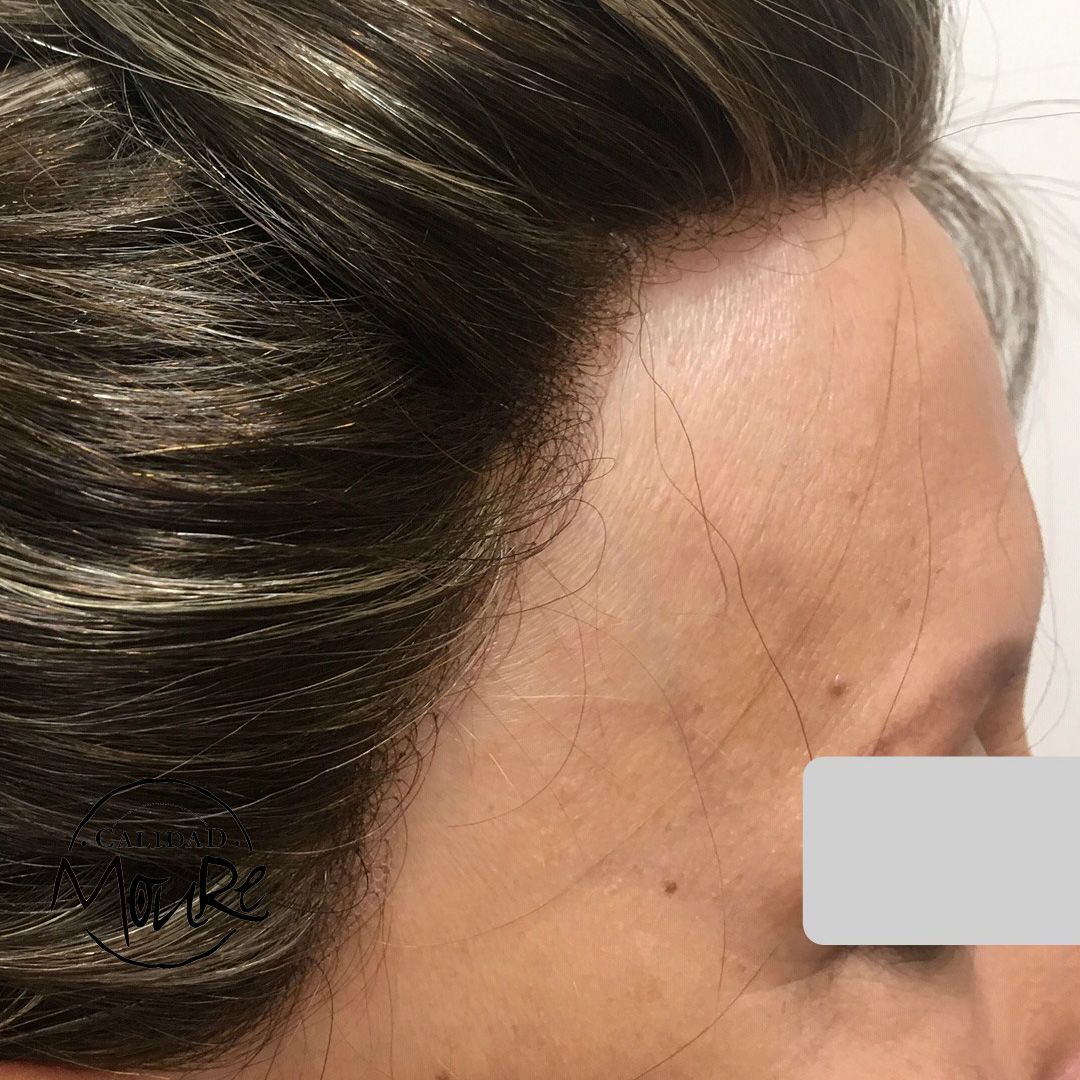 PROTESIS MALLA SUIZA MUJER MOURE (1)