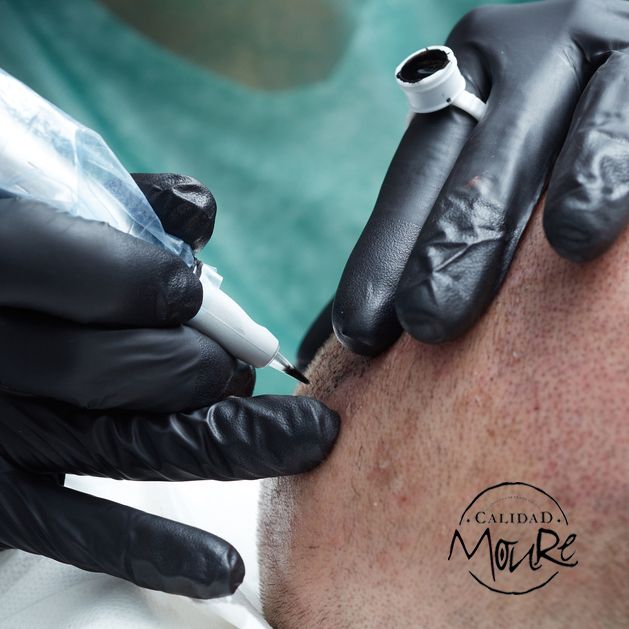 TECNICA MICROPIGMENTACION CAPILAR