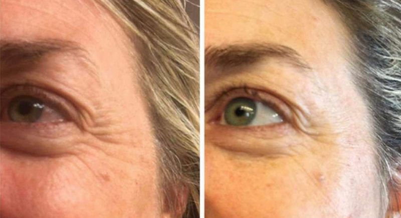 Antes y despues de hialuronico radiofreciencia, acidos y mesoterapia (2)