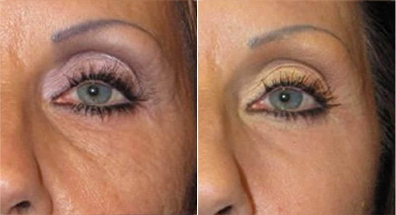 Antes y despues de hialuronico radiofreciencia, acidos y mesoterapia (3)