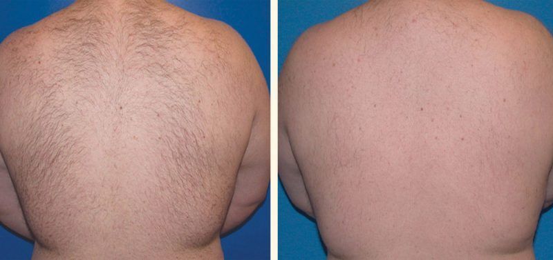 DEPILACION LASER HOMBRE CENTROS MOURE (3) MALLORCA