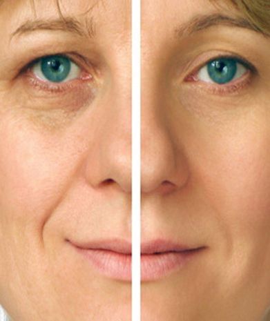 Fotorejuvenecimiento y acido hialuronico (3)