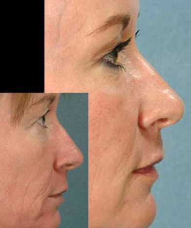 Fotorejuvenecimiento y acido hialuronico (4)