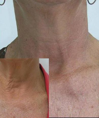 Fotorejuvenecimiento y acido hialuronico (6)