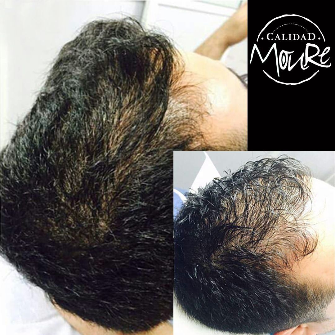 Micropigmentación capilar hombre relleno pelo largo (8)