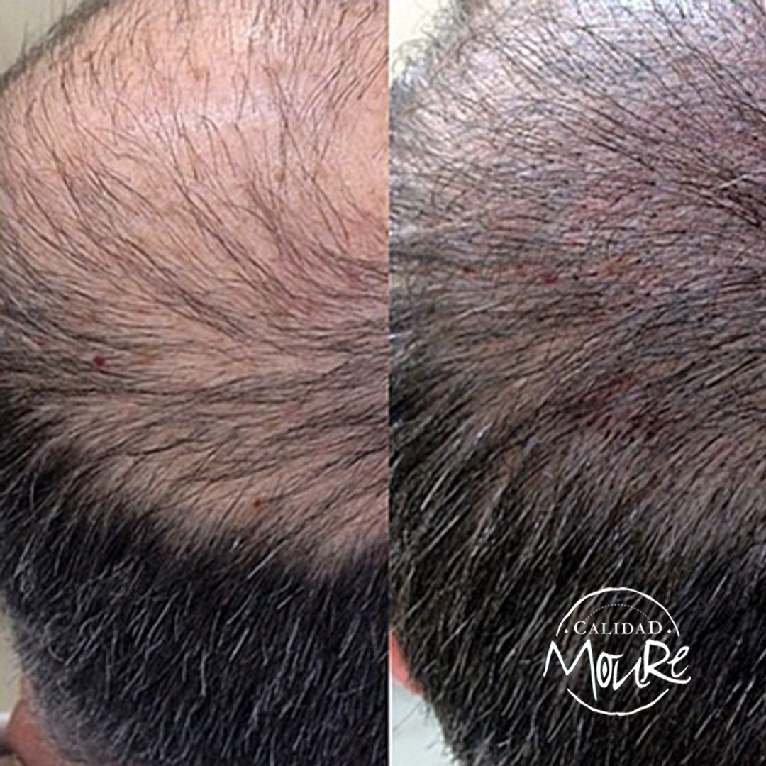 MICROPIGMENTACION CAPILAR CORONILLA UNA SESION