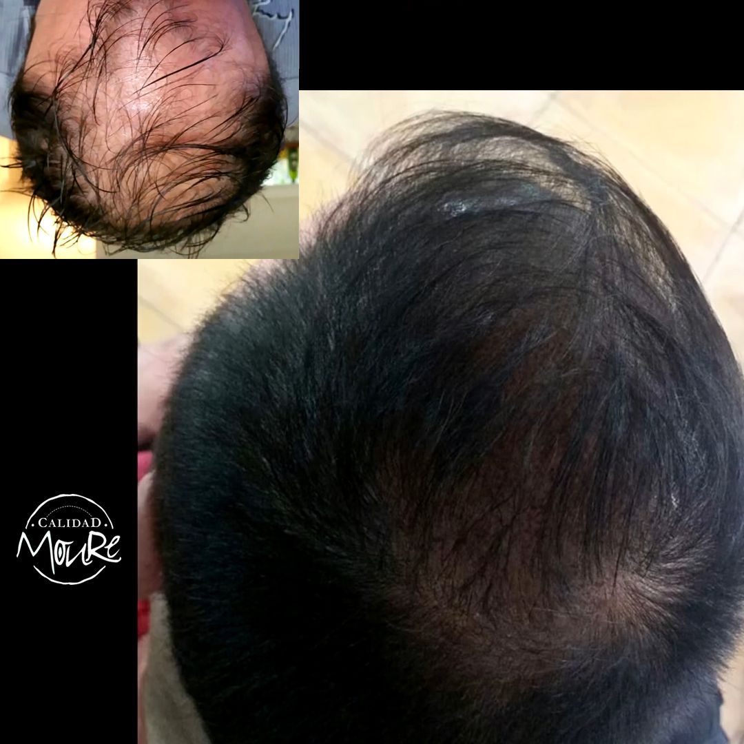 MICROPIGMENTACION CAPILAR PELO LARGO