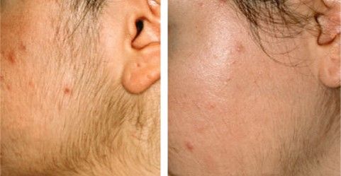 DEPILACION LASER MALLORCA (2)