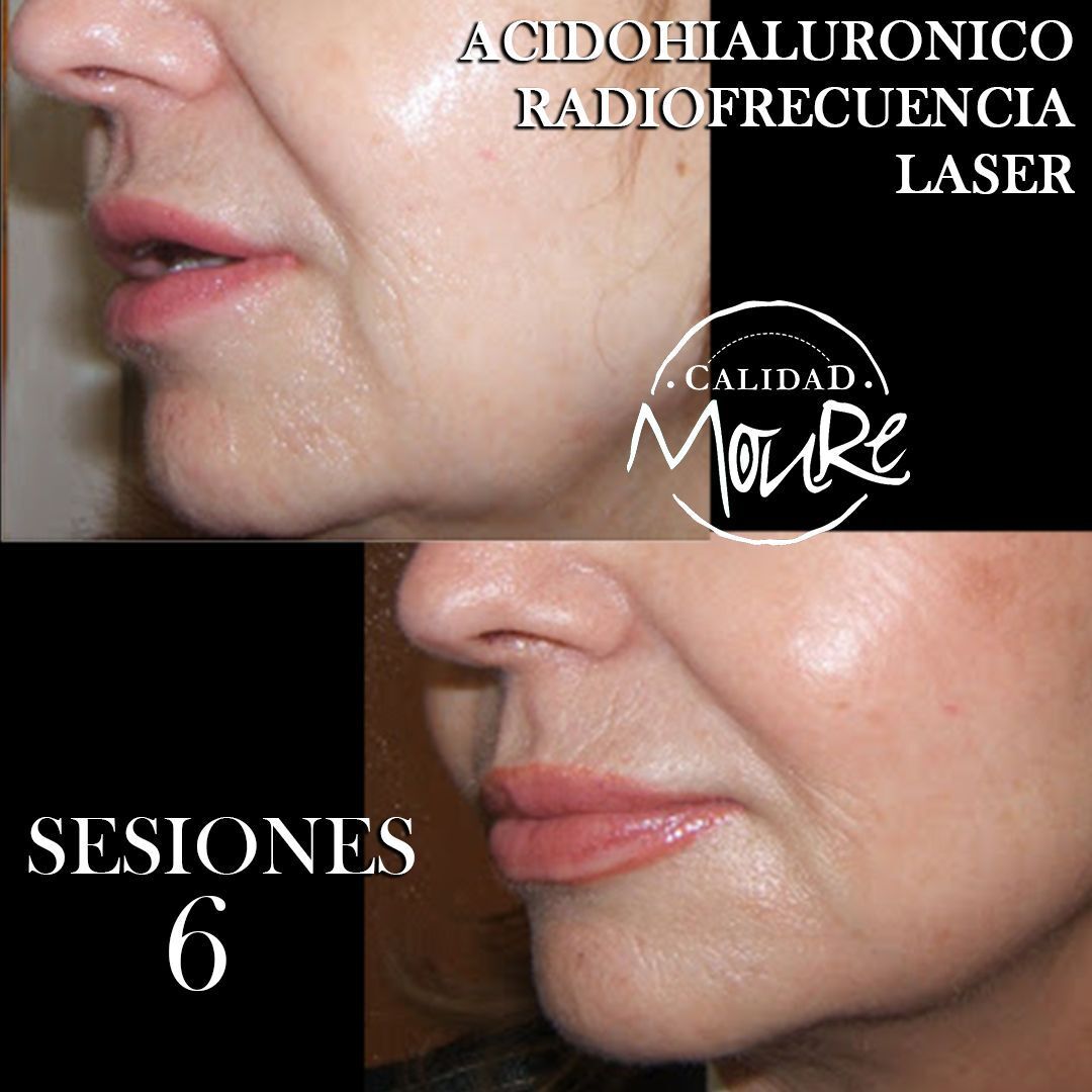 RADIOFRECUENCIA LASER GALVANICA Y ACIDO HIALURONICO CENTRO DE ESTETICA MOURE MALLORCA (10)