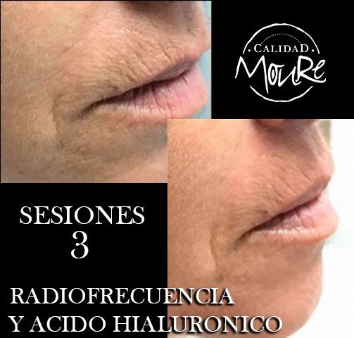 RADIOFRECUENCIA LASER GALVANICA Y ACIDO HIALURONICO CENTRO DE ESTETICA MOURE MALLORCA (12)