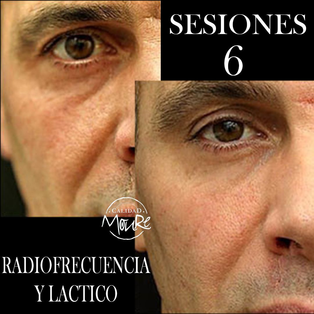 RADIOFRECUENCIA LASER GALVANICA Y ACIDO HIALURONICO CENTRO DE ESTETICA MOURE MALLORCA (13)