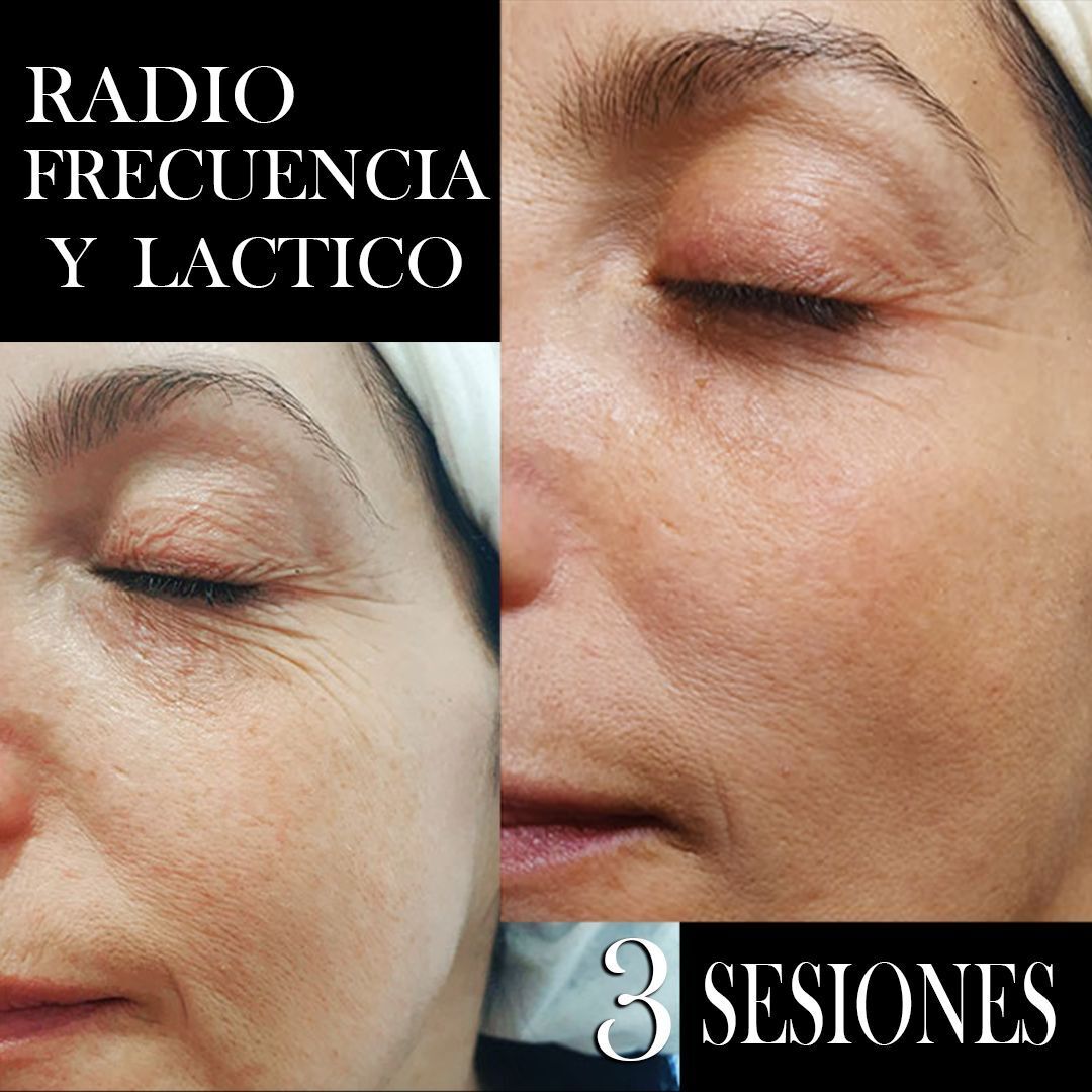 RADIOFRECUENCIA LASER GALVANICA Y ACIDO HIALURONICO CENTRO DE ESTETICA MOURE MALLORCA (5)